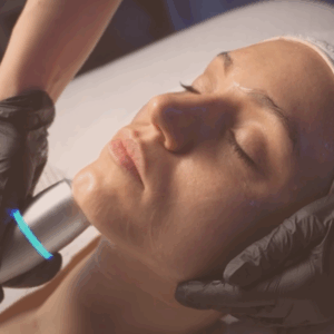 crioterapia facial en barcelona